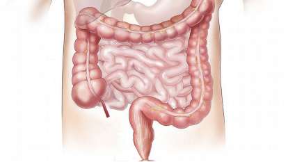 Intestino irritable